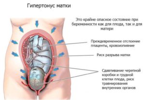 Сколько лежат в больнице с тонусом матки при беременности