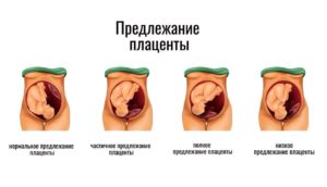 Центральное предлежание плаценты при беременности 20 недель
