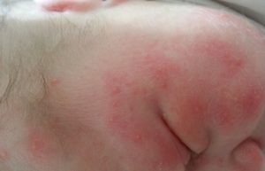 Токсическая Эритема У Новорожденных Причины И Последствия