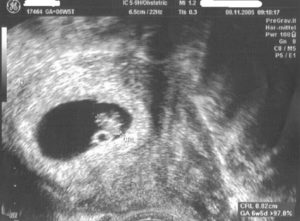 Беременность 7 акушерских недель сердцебиение