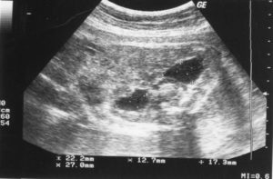 Повышенная эхогенность плаценты при беременности