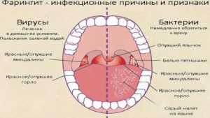 Вирусный Фарингит Симптомы И Лечение У Детей