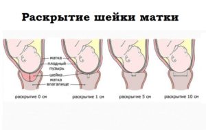 Незрелая шейка матки перед родами что делать