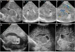Киста сосудистого сплетения головного мозга у плода на 20 неделе