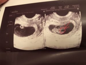 Гипертонус матки 6 недель беременности