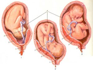 Краевое предлежание хориона 12 недель что это