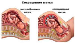 Матка В Тонусе На 41 Неделе Беременности