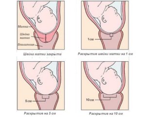Незрелая шейка матки перед родами что делать