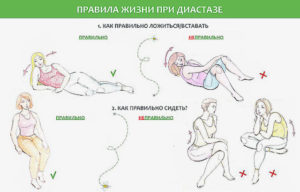 Упражнения после кесарева сечения для сокращения матки