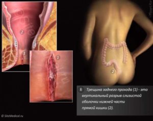 После родов колит в заднем проходе