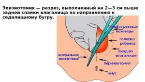 Наружные швы после родов когда можно садиться