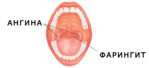 Вирусный Фарингит Симптомы И Лечение У Детей
