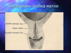 Незрелая шейка матки перед родами что делать