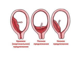 Краевое предлежание хориона 12 недель что это