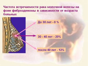 Нужно ли удалять фиброаденому молочной железы при менопаузе