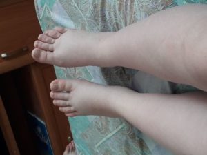 Отеки ног на 37 неделе беременности