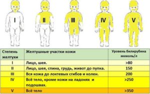 Форум Желтушка У Новорожденных Причины И Последствия