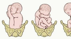 На 29 неделе беременности тазовое предлежание плода
