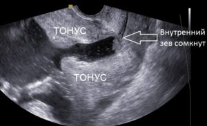 Гипертонус матки как выглядит на узи фото