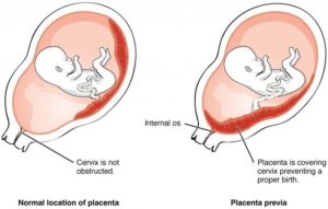 Низкое расположение плаценты при беременности 22 недели