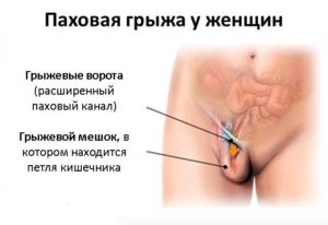 Болит в паху справа у женщин при беременности