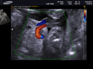 Единственная артерия пуповины при беременности причины и последствия
