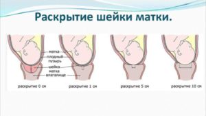 Раскрытие шейки матки на 1 палец когда начнутся роды