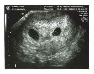 Фото узи 4 недели беременности двойня