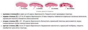 Степень зрелости плаценты на 32 неделе беременности