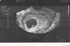 Не видно эмбриона на 8 неделе беременности
