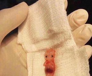 Как выглядит эмбрион в 5 недель фото при выкидыше