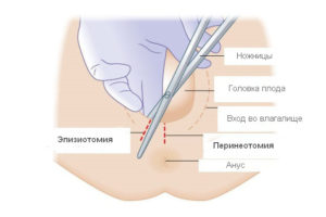 Как выглядит шов после эпизиотомии