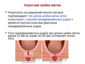 Короткая Шейка Матки При Беременности 16 Недель