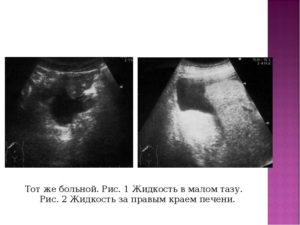 Свободной жидкости в малом тазу нет что это значит