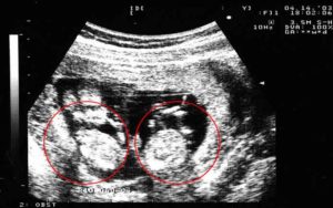 Признаки двойни на ранних сроках беременности без узи форум