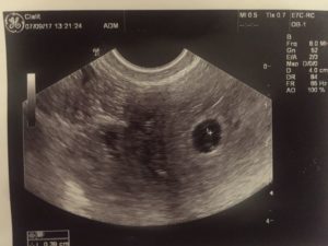 Почему не видно беременности. УЗИ эмбриона на 6 недели что видно. Яйцеклетка на УЗИ видна. 5 Недель беременности на УЗИ не видно эмбриона. Плодовое яйцо без эмбриона.