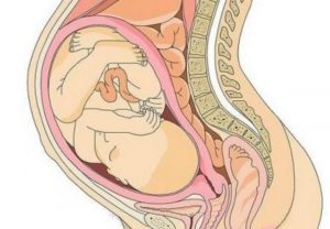 Плацента по задней стенке матки с переходом на дно