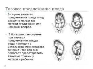 Тазовое предлежание плода на 30 неделе беременности причины и последствия