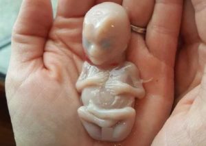 Как выглядит эмбрион в 4 недели при выкидыше фото