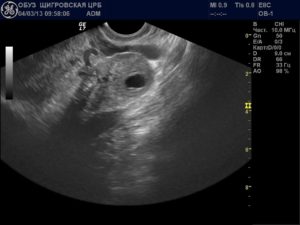 Желтое тело 9 неделе беременности