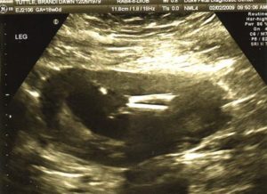 18 Недель беременности гипертонус