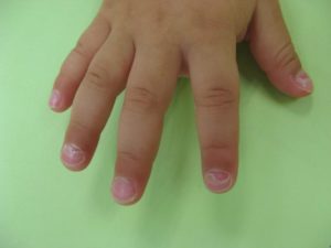 У Ребенка Облазят Ногти На Руках Фото