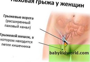 Болит в паху справа у женщин при беременности
