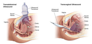 Делают ли трансвагинальное узи девственницам