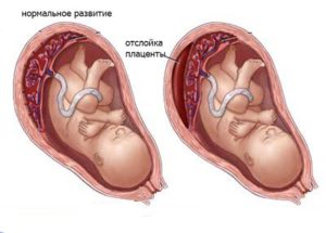 Отслойка плаценты на 9 неделе беременности