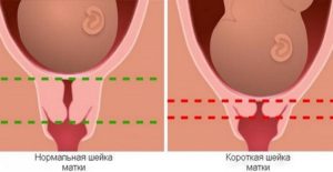 Шейка матки короткая на 34 неделе беременности