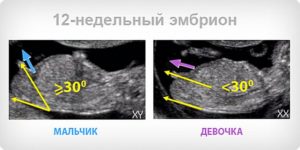 Можно ли определить пол ребенка в 12 недель по узи скрининг