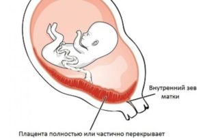 Плацента по задней стенке матки перекрывает внутренний зев