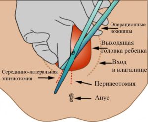 Почему после эпизиотомии нельзя сидеть