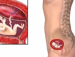 Живот крутит во время беременности